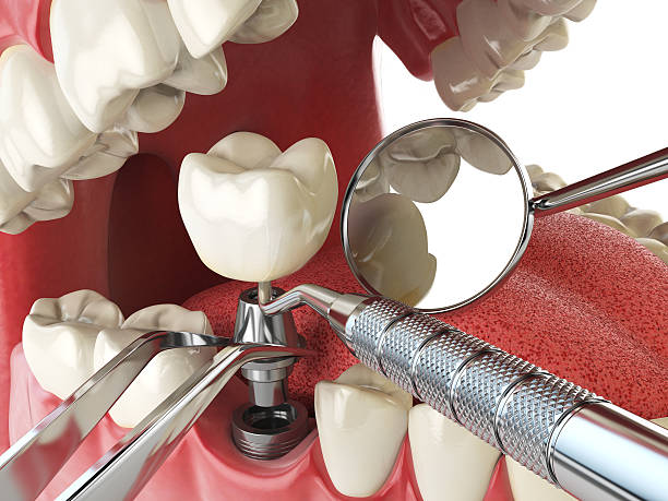 Best Emergency Root Canal Treatment in Solomon, KS
